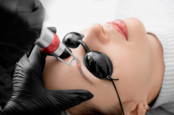 Qui propose le microneedling  